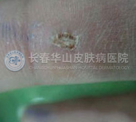 主要因摩擦挤压而形成的小圆硬块,形态像鸡的眼睛,按压有疼痛!